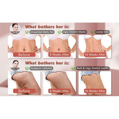 Cordless Cellulite Stretch Marks Skin Tightening Fat Burner Massager